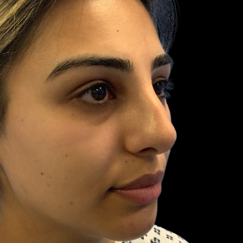 ethnic-rhinoplasty-before